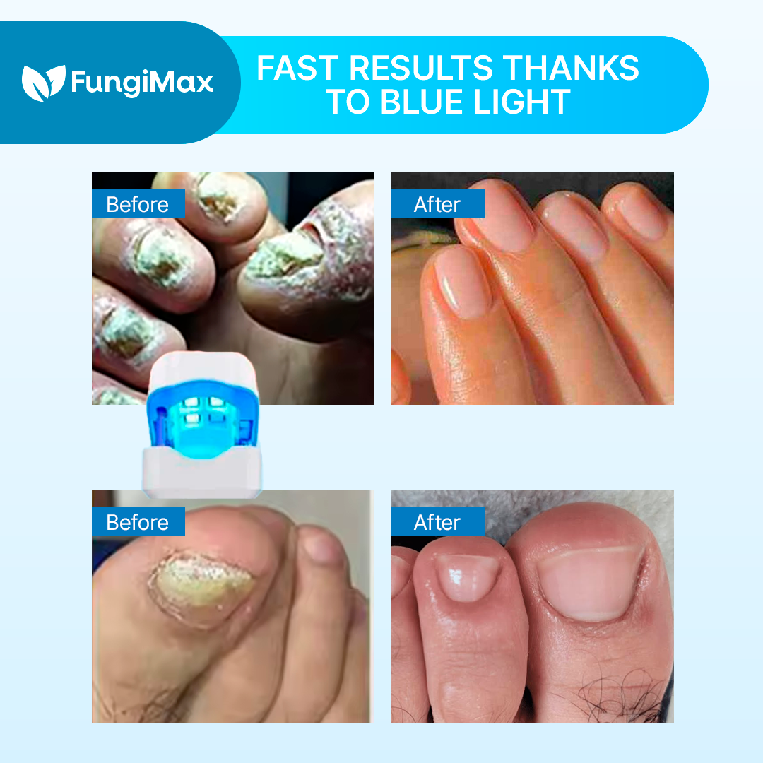 SAY GOODBYE TO NAIL FUNGUS WITHOUT PAIN, CREAMS OR MEDICATIONS